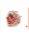 Agujas para Amniocentesis y Sistema de Toma de Muestra de Tejido Uterino